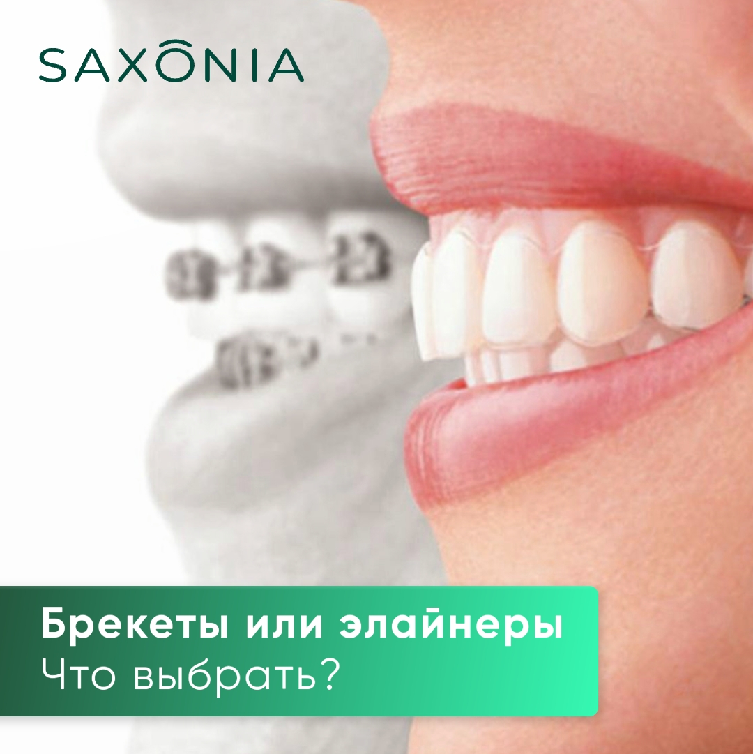 Брекеты или элайнеры. Что выбрать?