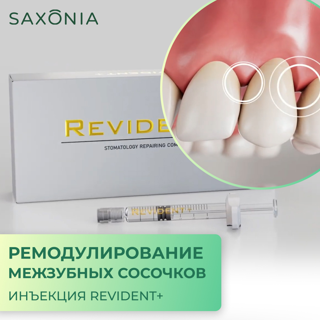 NEW! Процедура ремодулирования межзубных сосочков при помощи инъекции гиалуроновой кислоты REVIDENT+