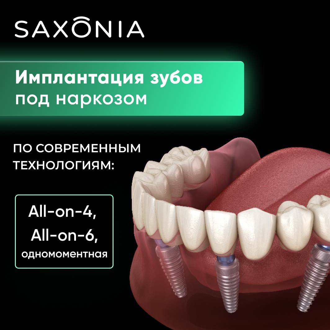 Имплантация во сне современными технологиями. All-on-4, All-on-6, одномоментная