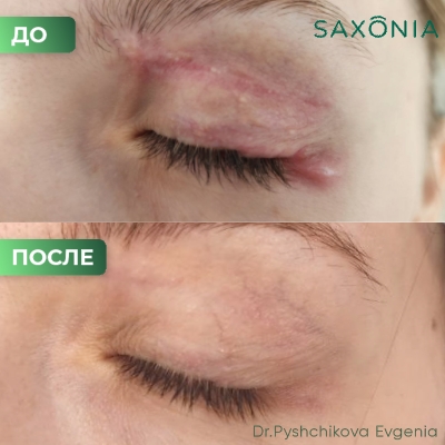 Прекрасный результат лечение рубца