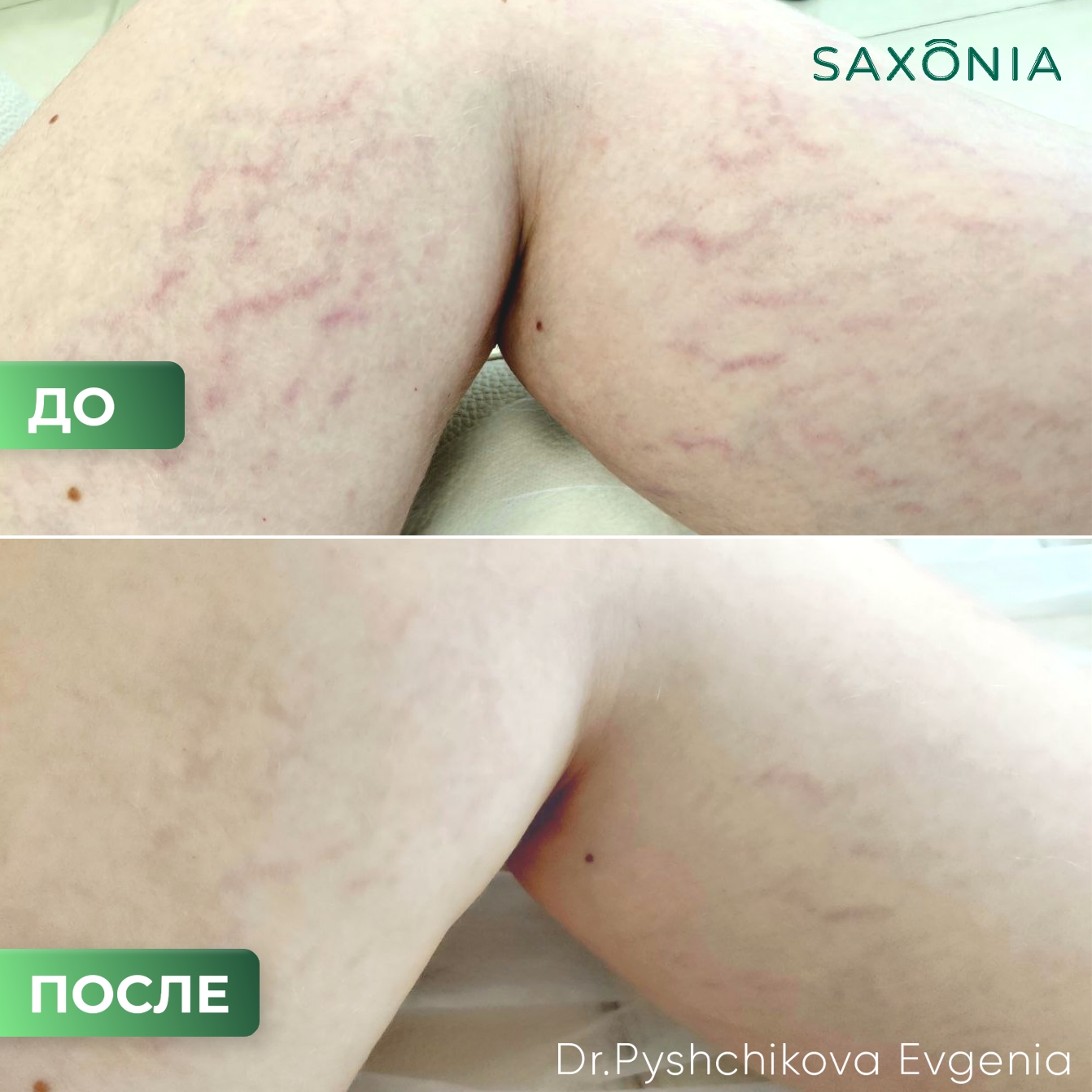 Результат лечения растяжек (стрий)