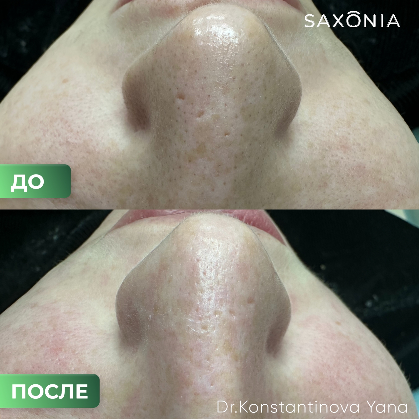 Результат комбинированной чистки лица