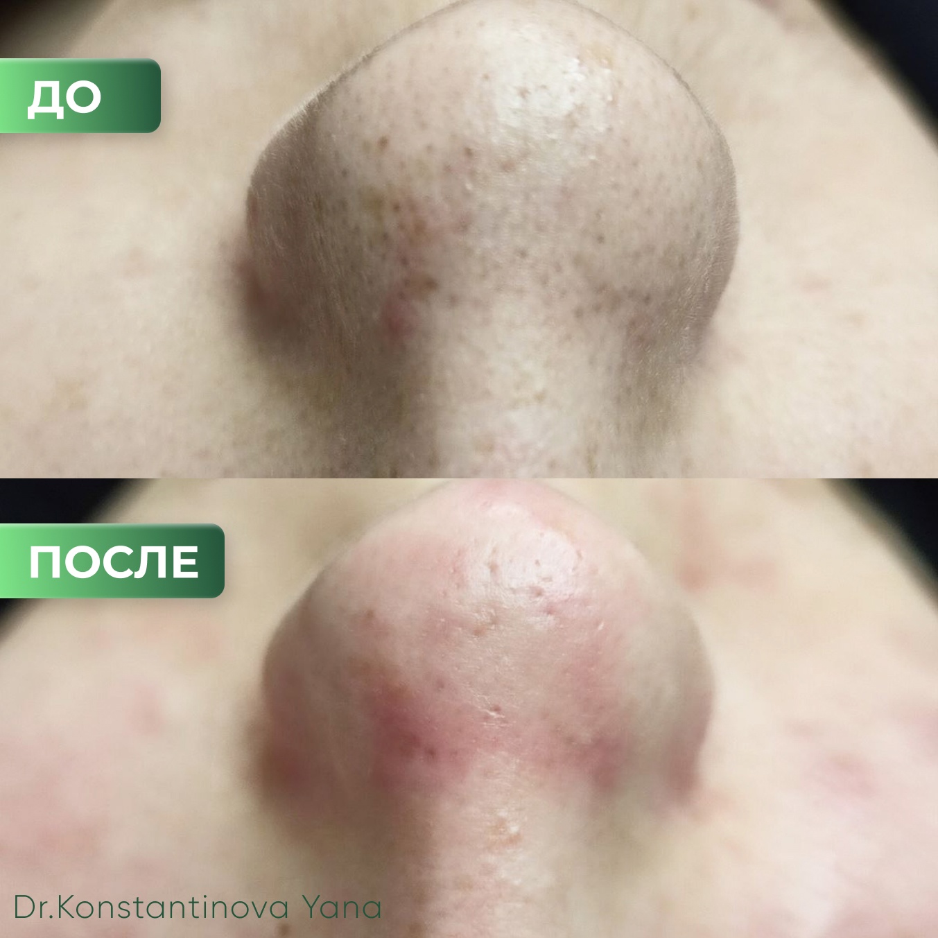 Чистая и сияющая кожа после процедуры мануальной чистки лица