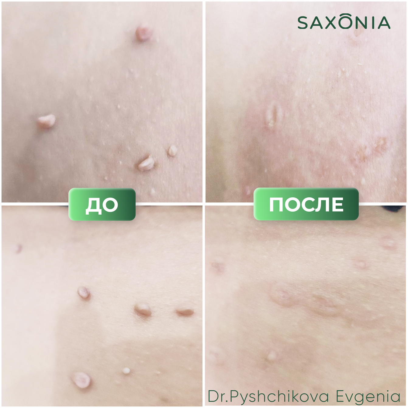 Удаление папиллом в области шеи