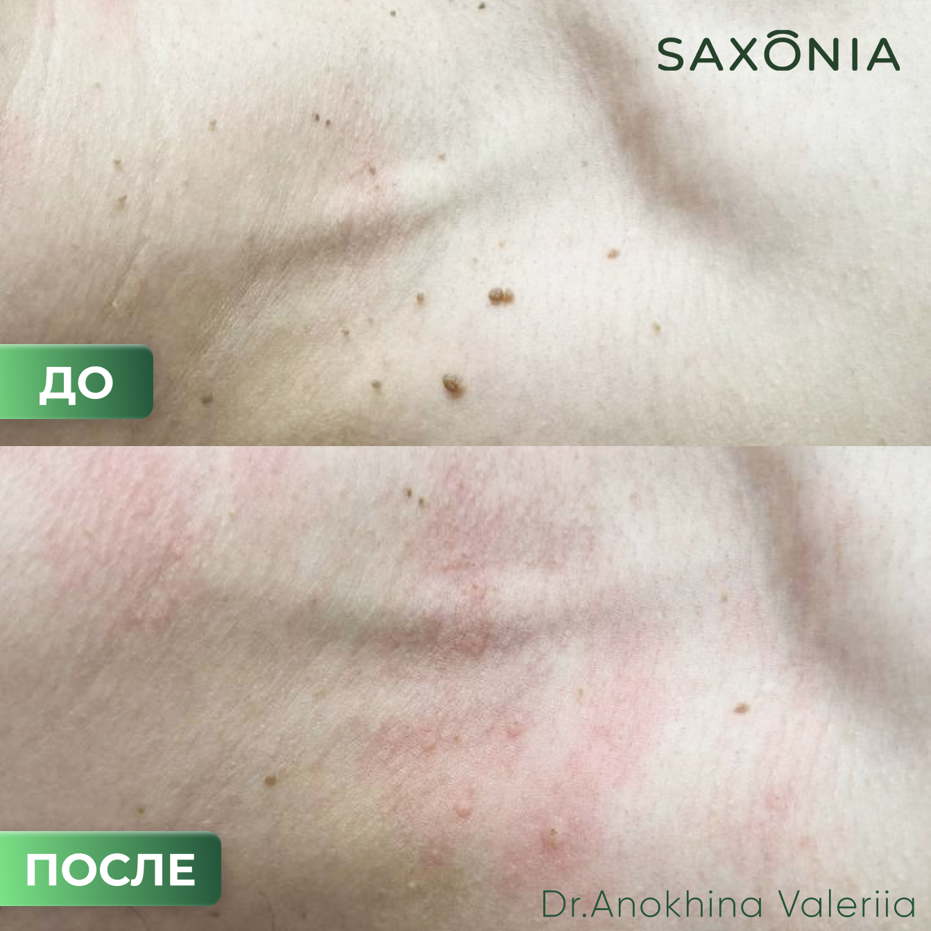 Результат удаления папиллом в зоне шеи и декольте сразу после процедуры