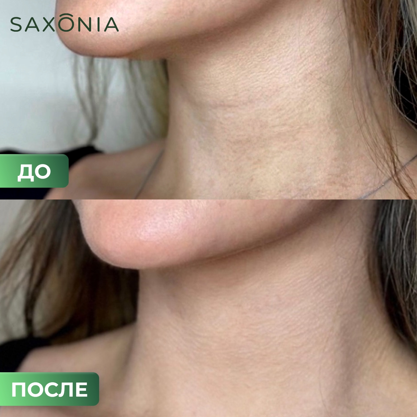 «Кольца Венеры» или когда кожа шеи выдает возраст?