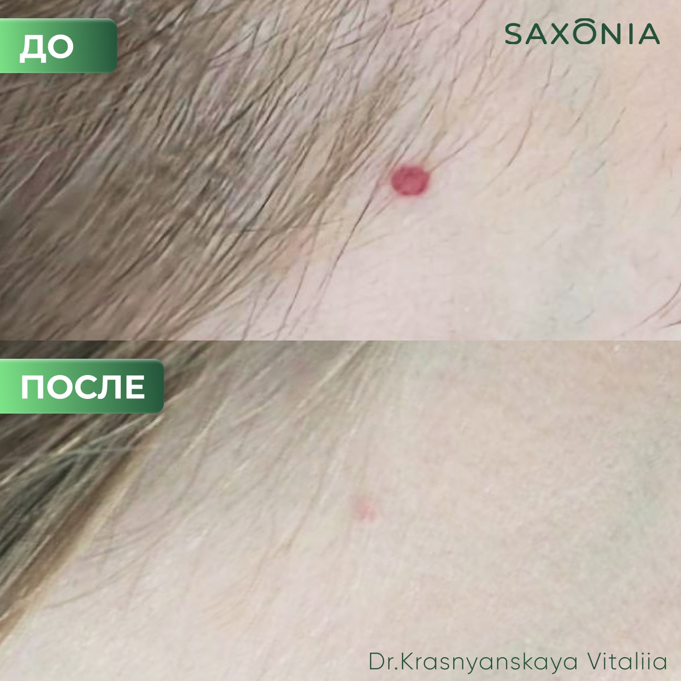Результат удаление гемангиомы на аппарате М22 сразу после процедуры!
