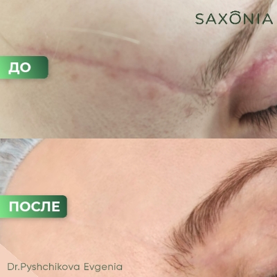 Лазерное лечение рубца на М22 Lumenis