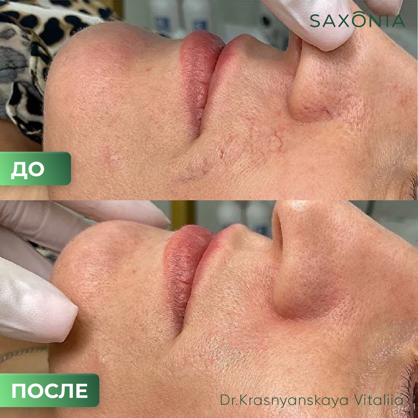 Результат лазерного удаления сосудов сразу после процедуры