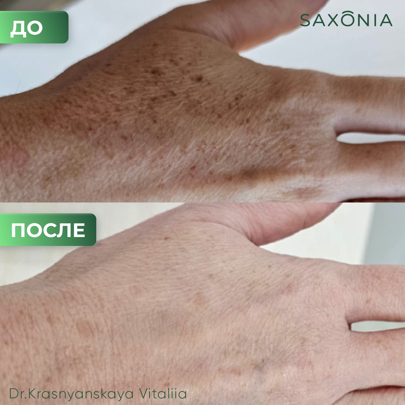 Омоложение кистей рук при помощи фототерапии