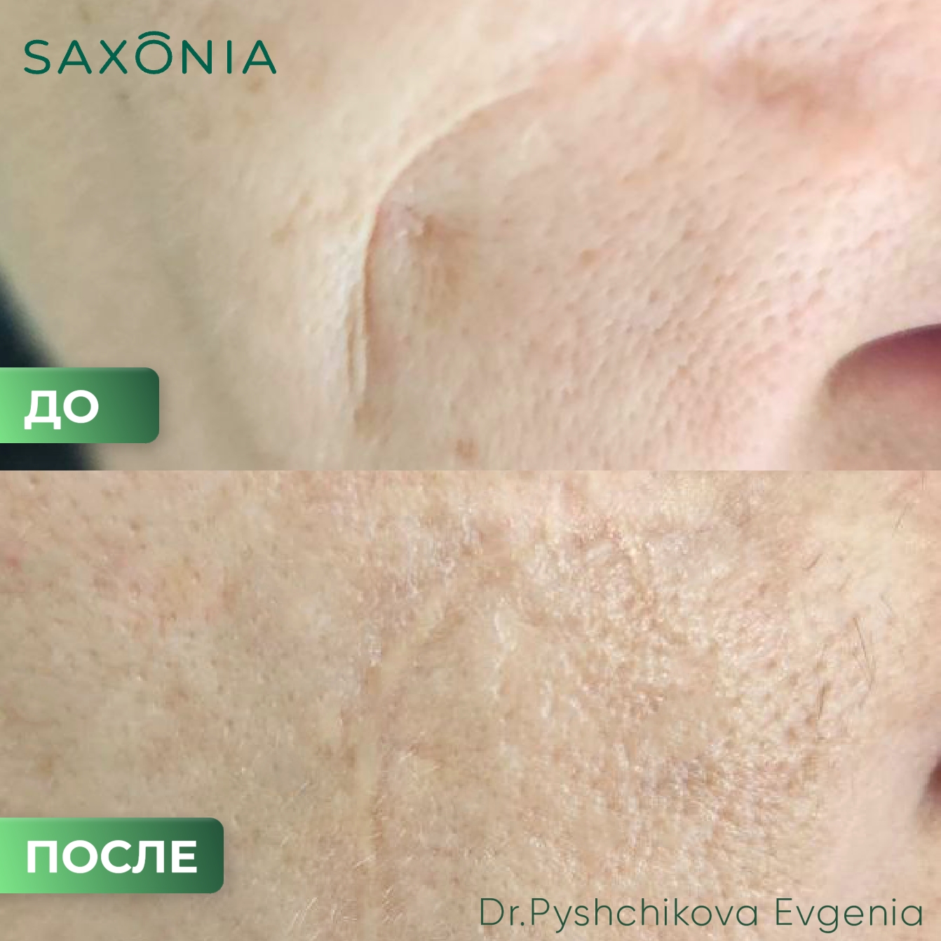 Результат лазерного лечения рубца