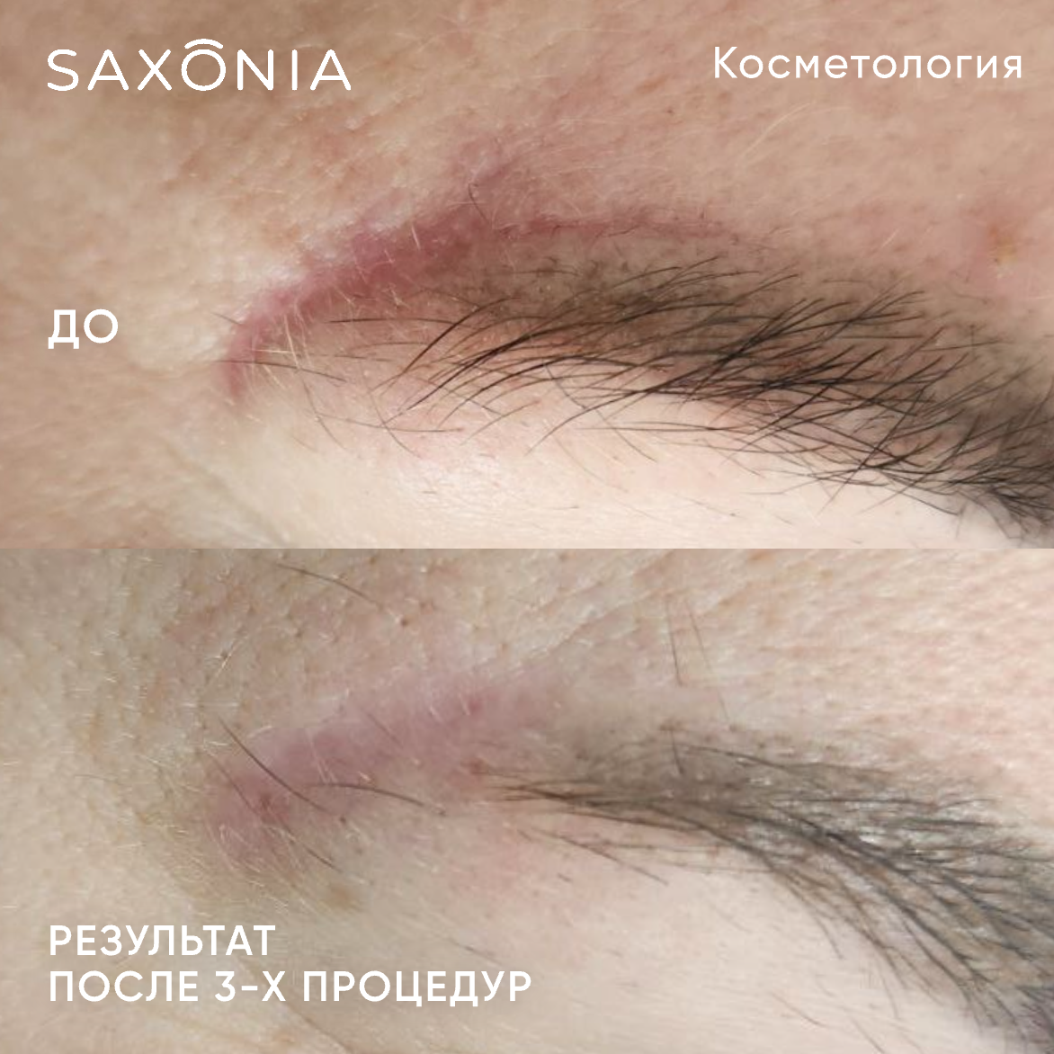 Результат 3-х процедур лазерного лечения рубца