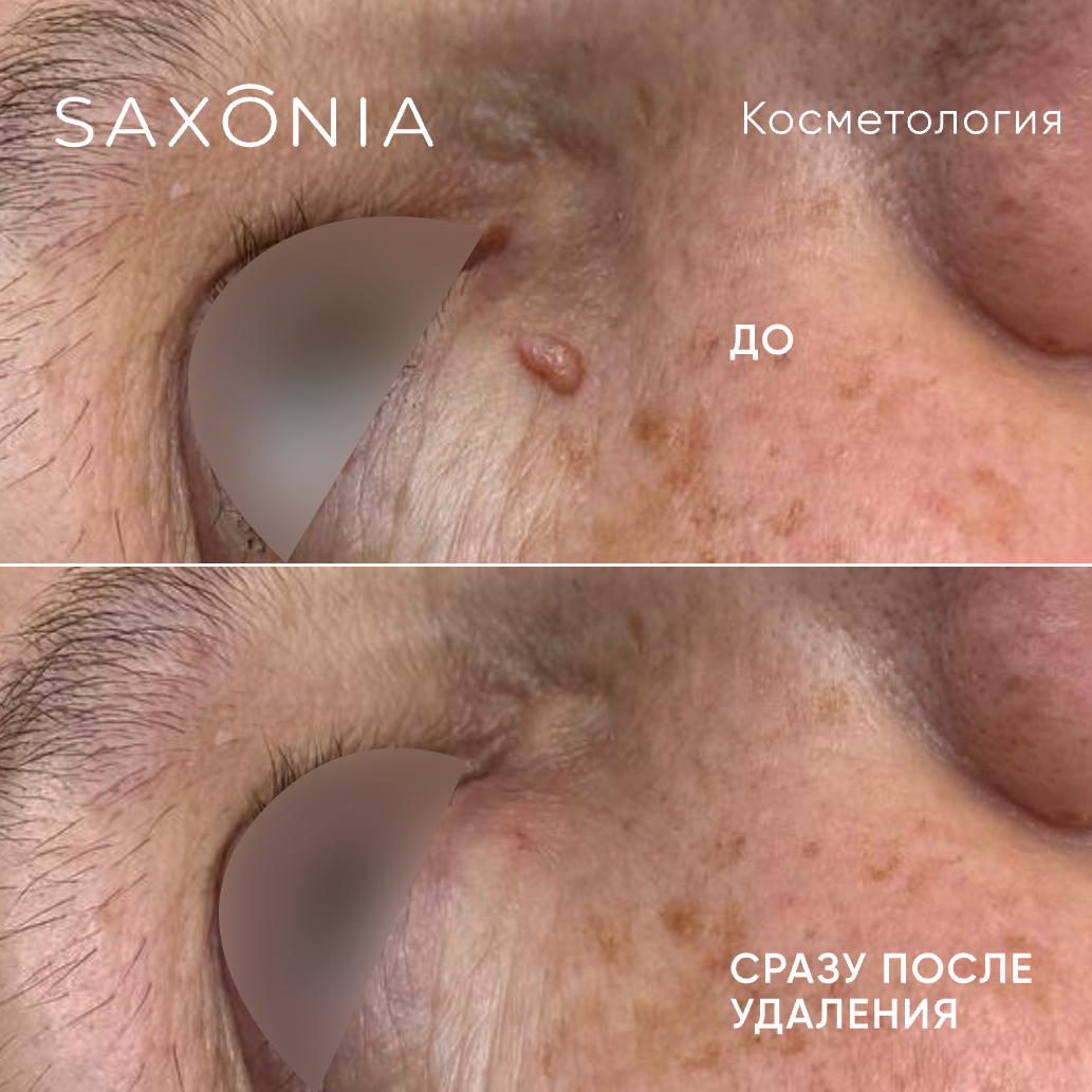 Деликатное удаление папилломы