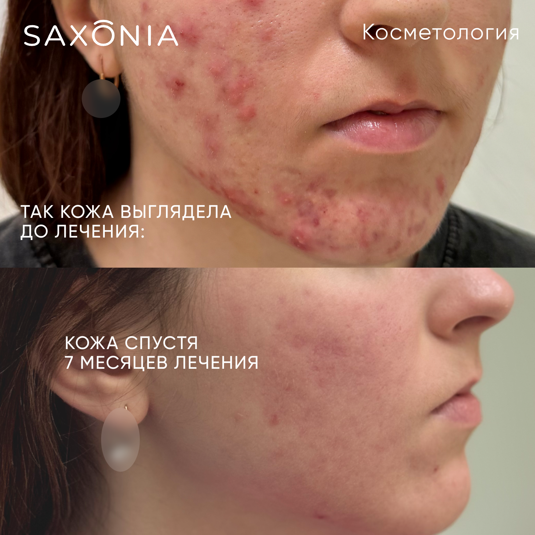 Лечения акне тяжелой степени тяжести