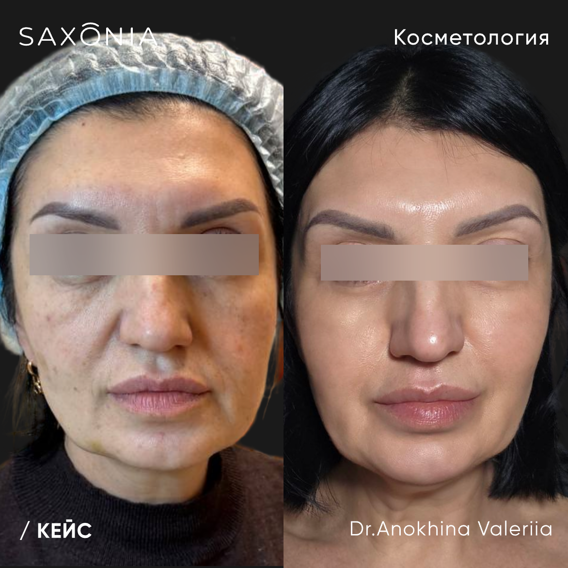 Комплексное омоложение по сочетанному протоколу