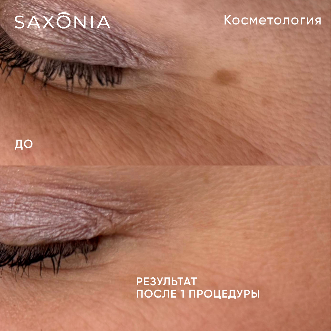 Устранение гиперпигментации
