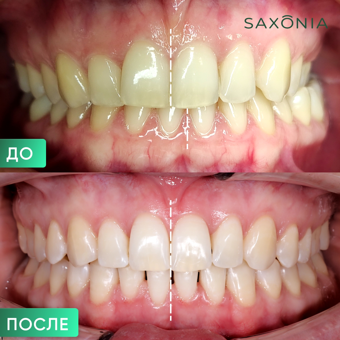 Успешное завершение ортодонтического лечения