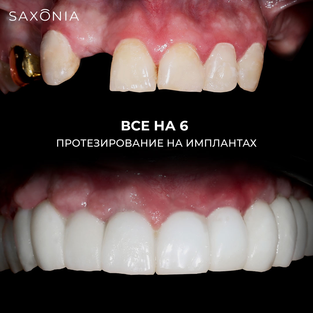 Успешное преображение по протоколу All-on-6 (все на 6-ти имплантах)