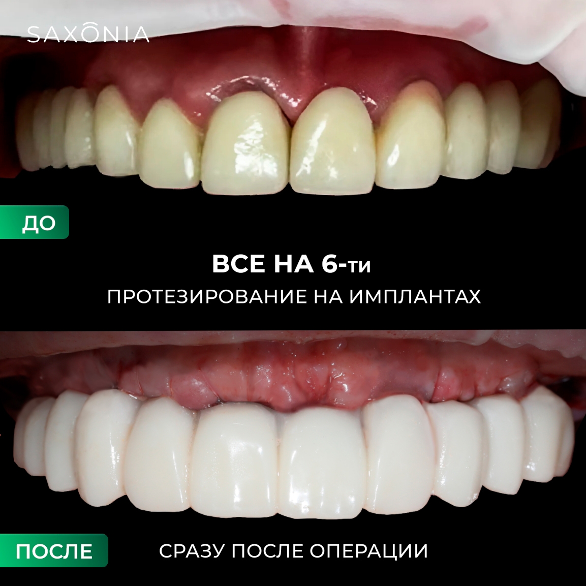 Комплексная имплантация в области верхней челюсти с использованием 6 имплантов (All-on-6)