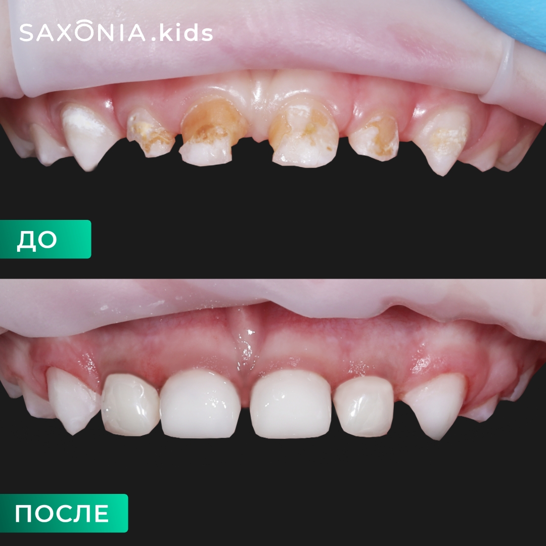 Лечение молочных зубов во сне