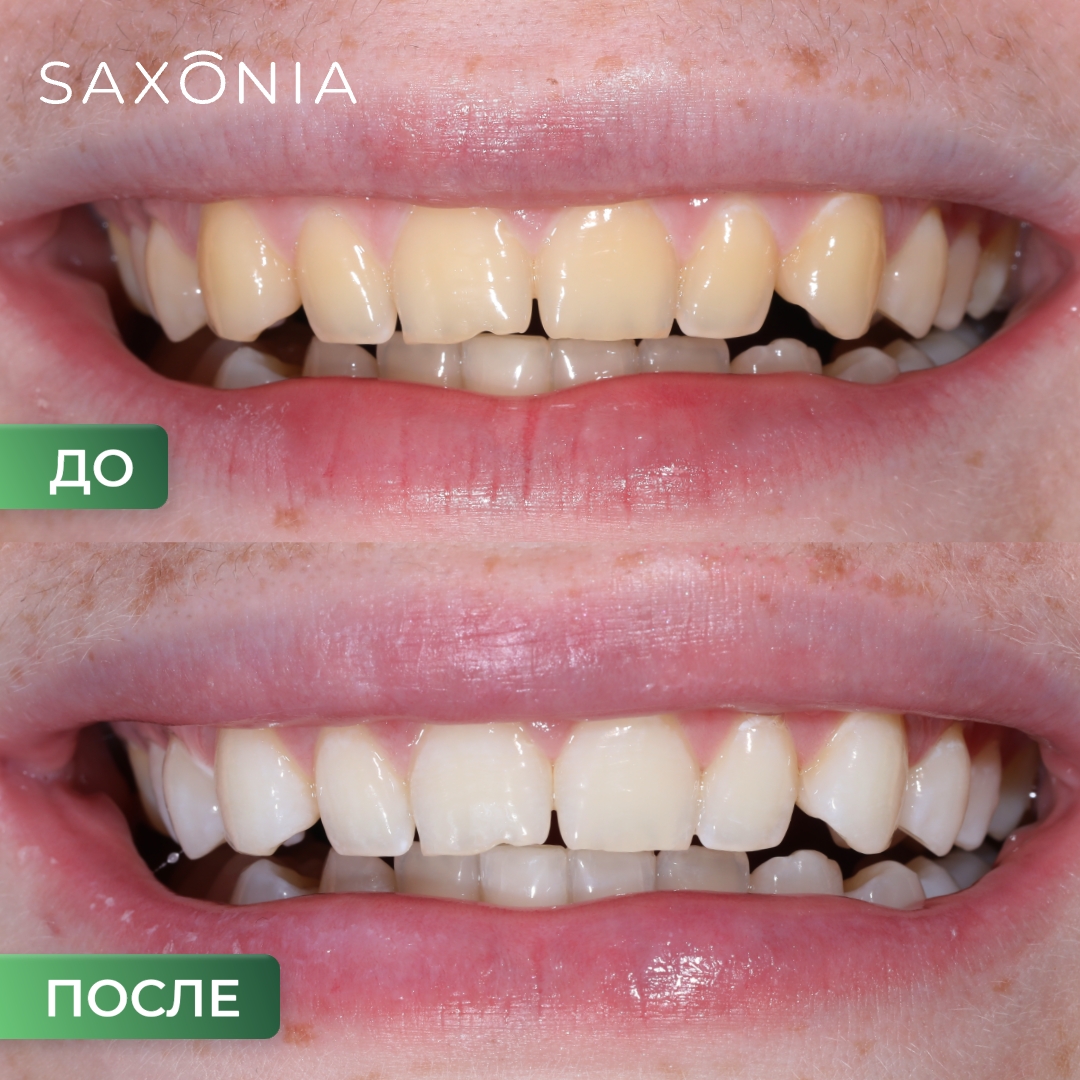 До/после: Отбеливание зубов — мечта о белоснежной улыбке сбылась!