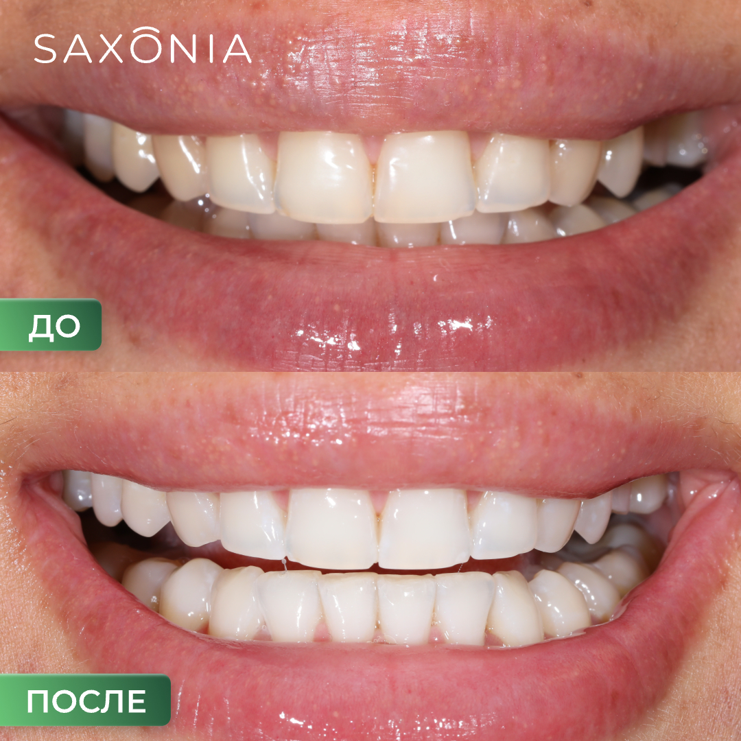 Профессиональное отбеливание зубов системой Flash WhiteSmile (Германия)