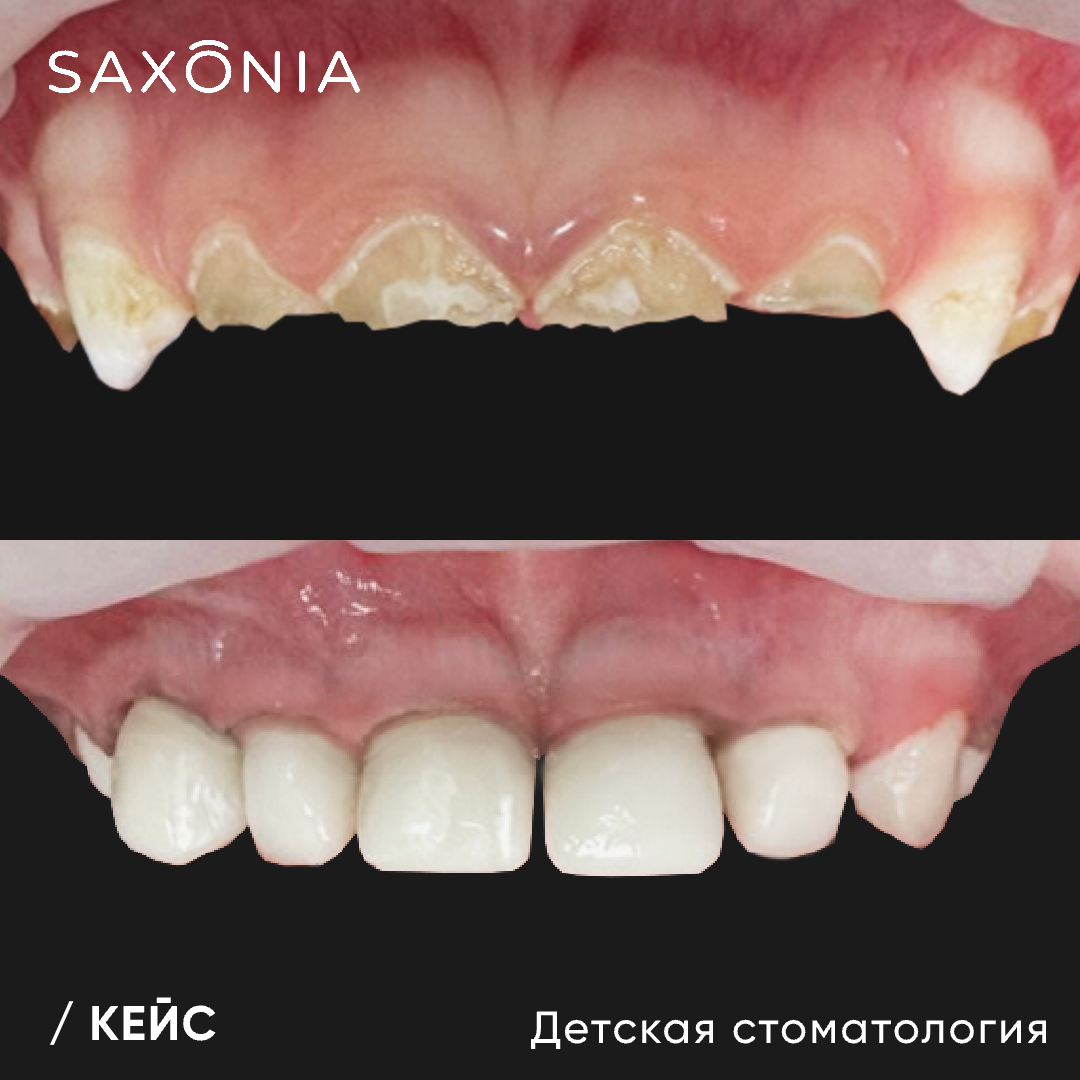 Лечение молочных зубов во сне маленькому пациенту